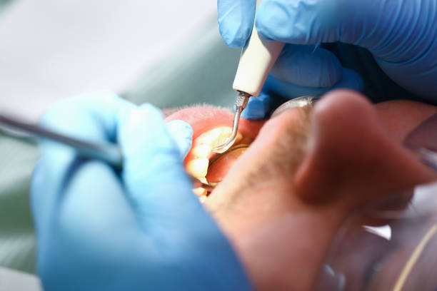 Best Emergency Wisdom Teeth Removal in Osborne, KS